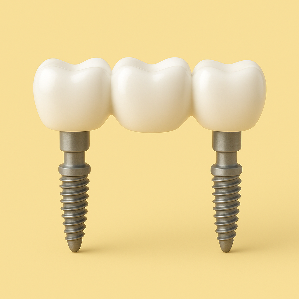 Le bridge sur implant